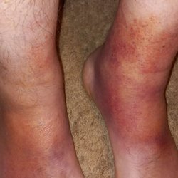 AdventHealth Oviedo ER - Here are my feet over the weekend I was there on Friday they were almost as bad and they just wrote it off as nothing