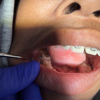 Image Orthodontics - Wire is poking through the other side - Orthodontists Near Me - South San Francisco, California Image Orthodontics - Wire is poking through the other side - Orthodontists Near Me - South San Francisco, California