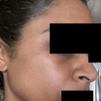 Epione - Immediately after dissolving the dark circle treatment I received at Epione the swelling stopped. This is 1 hour later. - Skin Care Near Me - Beverly Hills, California Epione - Immediately after dissolving the dark circle treatment I received at Epione the swelling stopped. This is 1 hour later. - Skin Care Near Me - Beverly Hills, California