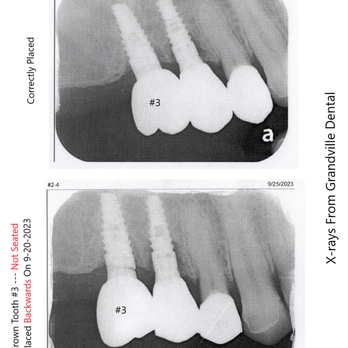 Sarah Palmer, DDS - Backward Dental Crown Shown In X-rays - Periodontists Near Me - Grandville, Michigan Sarah Palmer, DDS - Backward Dental Crown Shown In X-rays - Periodontists Near Me - Grandville, Michigan