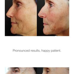 Mobile Glam NW - Collagen induction therapy that is less painful and you can go right back to work without that "Sunburned" feeling.