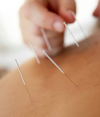 Acupuncture and Facial Rejuvenation Services - One of the services that Blue Jade Wellness is best known for is Acupuncture. With over 20 years of experience, Stacy is a board-certified diplomate of Acupuncture through the National Certification Commission of Oriental Medicine (NCCAOM). Stacy takes a very personal approach with her clients to ensure the highest level of care and understanding, and provides a level of care that is unparalleled to her clients. Our Acupuncture services treat the body and not the disease, making this service an effective healing tool for everything from the common cold to pain management to addiction and more. Stacy takes the time necessary to build long lasting relationships with her clients, making sure they are comfortable and properly educated, ensuring impactful results and relaxation.

 
Additionally, Stacy also performs Facial Rejuvenation Acupuncture, which is a painless, non-surgical method of reducing the signs of the aging process. The service may erase as many as five to fifteen years from the face, with results after just a few treatments. Through Stacy’s experience, she’s able to help lessen or entirely eliminate fine lines, and the service may diminish deep wrinkles, reduce bags under the eyes, eliminate puffiness, lift droopy eyelids, minimize double chins, and sculpt jawlines. There are many more benefits to Facial Rejuvenation Acupuncture, as well! 
Stacy’s client testimonials speak for themselves, feel free to view some of them in this portfolio. Give Stacy a call at Blue Jade Wellness today to schedule an appointment!