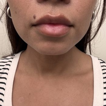 V Line Cosmetic Clinic - Day 2 after lip filler 1 syringe. - Skin Care Near Me - Arcadia, California V Line Cosmetic Clinic - Day 2 after lip filler 1 syringe. - Skin Care Near Me - Arcadia, California