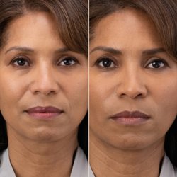 RHA- the most natural filler on the market