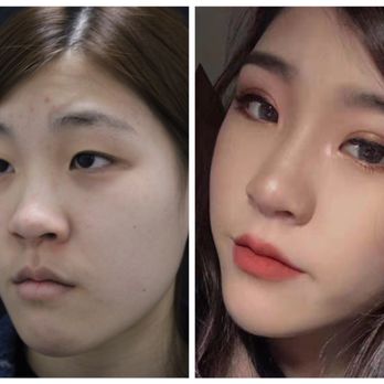 Premier Cosmetic Surgery & MedSpa - Double eyelid surgery + Nose filler - Cosmetic Surgeons Near Me - Arcadia, California