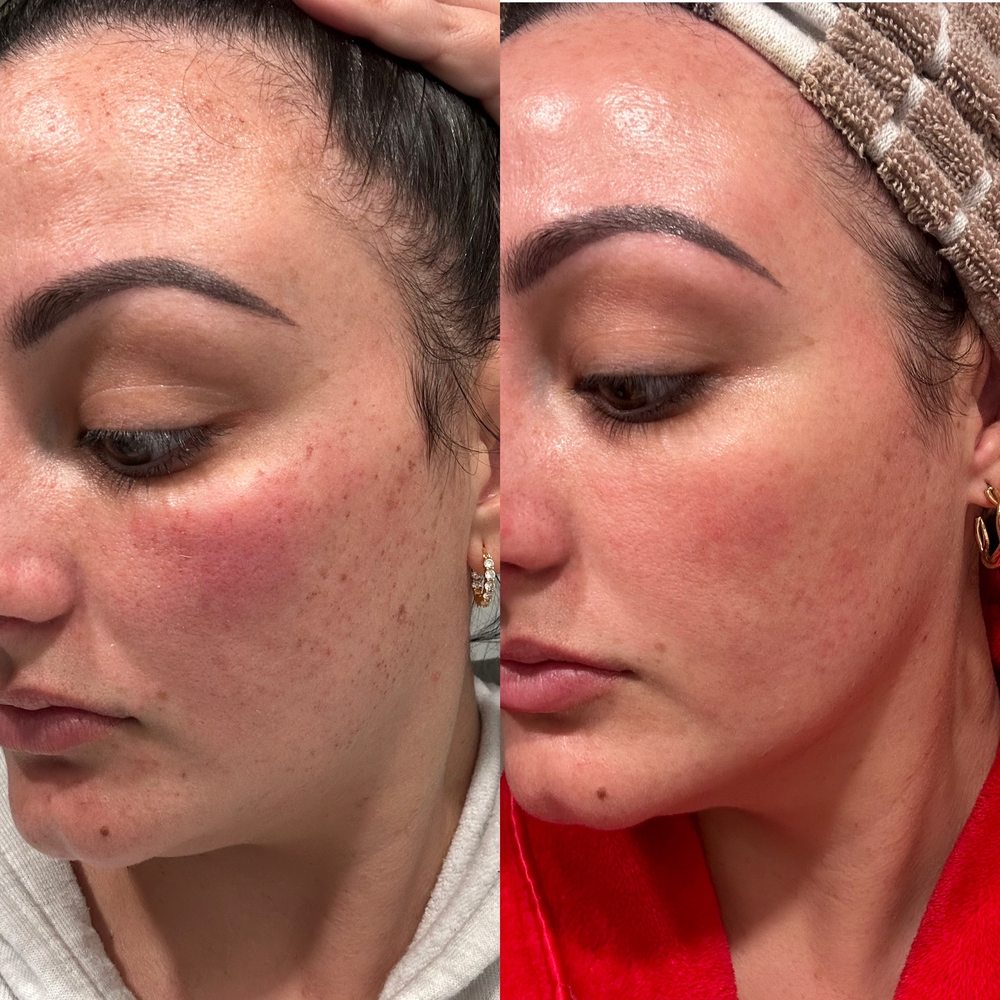Timeless Surgical Center - IPL- only after ONE SESSION! I can't wait to see the final result after my second session. - Skin Care Near Me - Palm Harbor, Florida Timeless Surgical Center - IPL- only after ONE SESSION! I can't wait to see the final result after my second session. - Skin Care Near Me - Palm Harbor, Florida