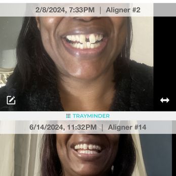 Valley Arts Dental - Aligner #2 Top Jan 2024
Aligner #14 Bottom June 2024 - General Dentistry Near Me - West Orange, New Jersey Valley Arts Dental - Aligner #2 Top Jan 2024
Aligner #14 Bottom June 2024 - General Dentistry Near Me - West Orange, New Jersey