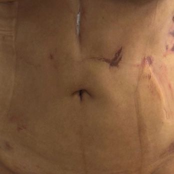 Augusto Rojas, MD - Quemadas de cánula Lipo - Cosmetic Surgeons Near Me - Los Angeles, California
