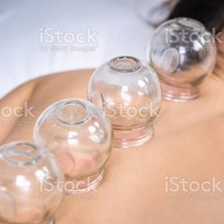 Acupuncture Plus Holistic center - Cupping releases toxins and relaxes the deep muscles.