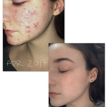 Swedish Skin Institute - April 2017-February 2018 - Laser Hair Removal Near Me - Chicago, Illinois Swedish Skin Institute - April 2017-February 2018 - Laser Hair Removal Near Me - Chicago, Illinois
