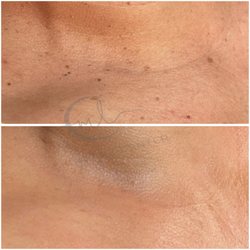 ML Skincare Center - Remoción de acrocordones e hidratación .