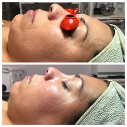 Smooth A Peel - Before and after of our new Hydro Luxx Facial