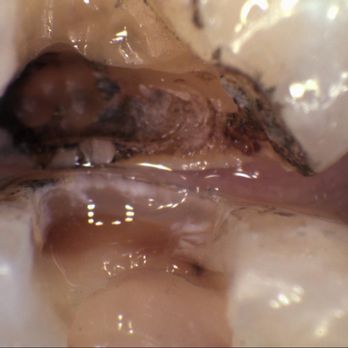 Anna K Choe, DDS - Would you want a filling OVER this decay? This is what Dr. Chang filled OVER! - General Dentistry Near Me - Pasadena, California