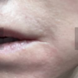 Robertson Cosmetic Center - 11 mo post erbium