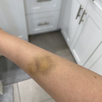 Adventure Playground - Bruise from kid throwing blocks - Playgrounds Near Me - Irvine, California