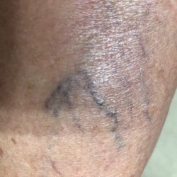 U.S. Dermatology Partners - AFTER TWO (over $600 spent) sessions of Sclerotherapy at US DERMATOLOGY PARTNERS in Paris, TX..I was told, "too bad, no guarantees!"