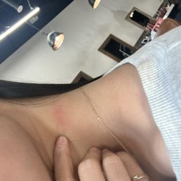 Skin got irritated Skin got irritated