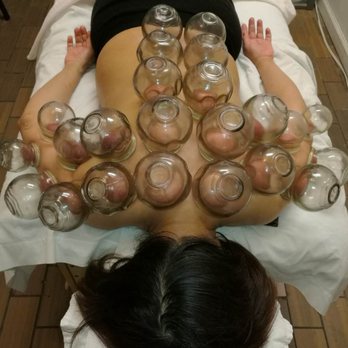 Super Acucare - Cupping - Acupuncture Near Me - Philadelphia, Pennsylvania Super Acucare - Cupping - Acupuncture Near Me - Philadelphia, Pennsylvania