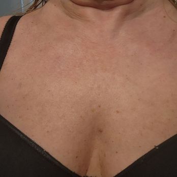 Opal Aesthetics - My chest at 60 something, unbelievably!! - Skin Care Near Me - Johns Island, South Carolina Opal Aesthetics - My chest at 60 something, unbelievably!! - Skin Care Near Me - Johns Island, South Carolina