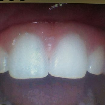 Sachin P Desai, DDS - This is my final look!!!! What chippings? None! Dr. is such a pro!! - Cosmetic Dentists Near Me - Glendora, California Sachin P Desai, DDS - This is my final look!!!! What chippings? None! Dr. is such a pro!! - Cosmetic Dentists Near Me - Glendora, California