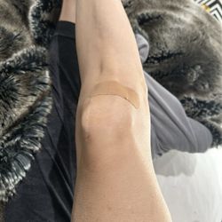 Center for Rheumatology - My knee today. Most gentle, least painful shot I've ever gotten in my knee was yesterday with Dr. Tran.