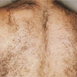 Franklin Skin and Laser - Before-Laser Hair Removal
