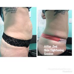 Skin Tightening Treatments
