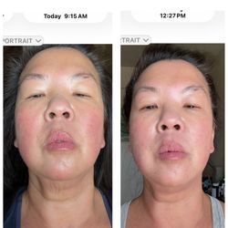 Jasmine Yun, MD - Before & right after Sofwave, with time stamps