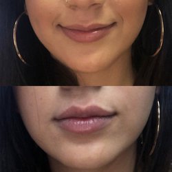 Ten Years Younger - Lip augmentation. Actual Ten Years Younger client.