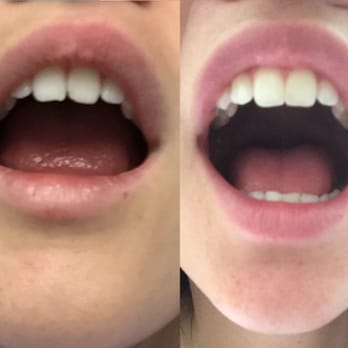 Fred Chao, DDS - Before and after. Super happy! - General Dentistry Near Me - Los Angeles, California Fred Chao, DDS - Before and after. Super happy! - General Dentistry Near Me - Los Angeles, California