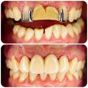 SpringLake Dental - Before and After - Cosmetic Dentists Near Me - Woodland, California SpringLake Dental - Before and After - Cosmetic Dentists Near Me - Woodland, California
