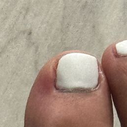 Infected toe