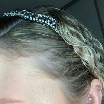 Scalp Studio - Other side of scalp after two sessions - Hair Loss Centers Near Me - San Diego, California Scalp Studio - Other side of scalp after two sessions - Hair Loss Centers Near Me - San Diego, California