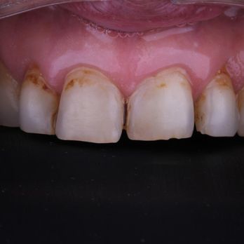 Sm4 Smile Method For All - Before - Cosmetic Dentists Near Me - Tijuana, BCN