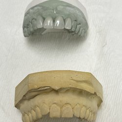 David Gelman's Dental Laboratory Inc - PALTINUM FOIL VENEERS