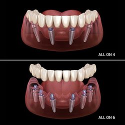 Titanium Surgical Arts