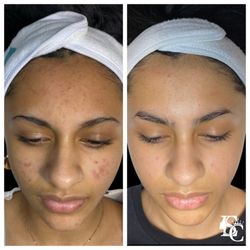 Eneeva Skin Care - Teen Before & After Face Reality Acne Boot Camp
