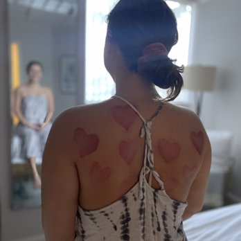 Tranquility Massage & Thai Healing Spa - Cupping Therapy *Alleviate symptoms by promoting blood circulation and improving immunity while experiencing a deep tissue release - Massage Near Me - Delray Beach, Florida Tranquility Massage & Thai Healing Spa - Cupping Therapy *Alleviate symptoms by promoting blood circulation and improving immunity while experiencing a deep tissue release - Massage Near Me - Delray Beach, Florida
