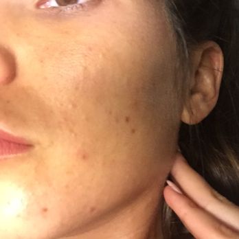 Personal Esthetics - Before- that texture! Ugghhhh - Skin Care Near Me - Washington, DC, District of Columbia