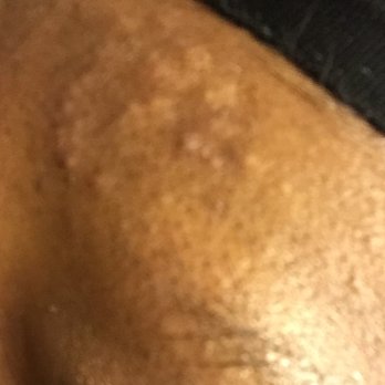 Ava Nails Spa - This happened after a tech waxed my eyebrows supposedly after she washed her hands after taking the trash out. I had to ask for her to wash. - Waxing Near Me - Charlotte, North Carolina Ava Nails Spa - This happened after a tech waxed my eyebrows supposedly after she washed her hands after taking the trash out. I had to ask for her to wash. - Waxing Near Me - Charlotte, North Carolina