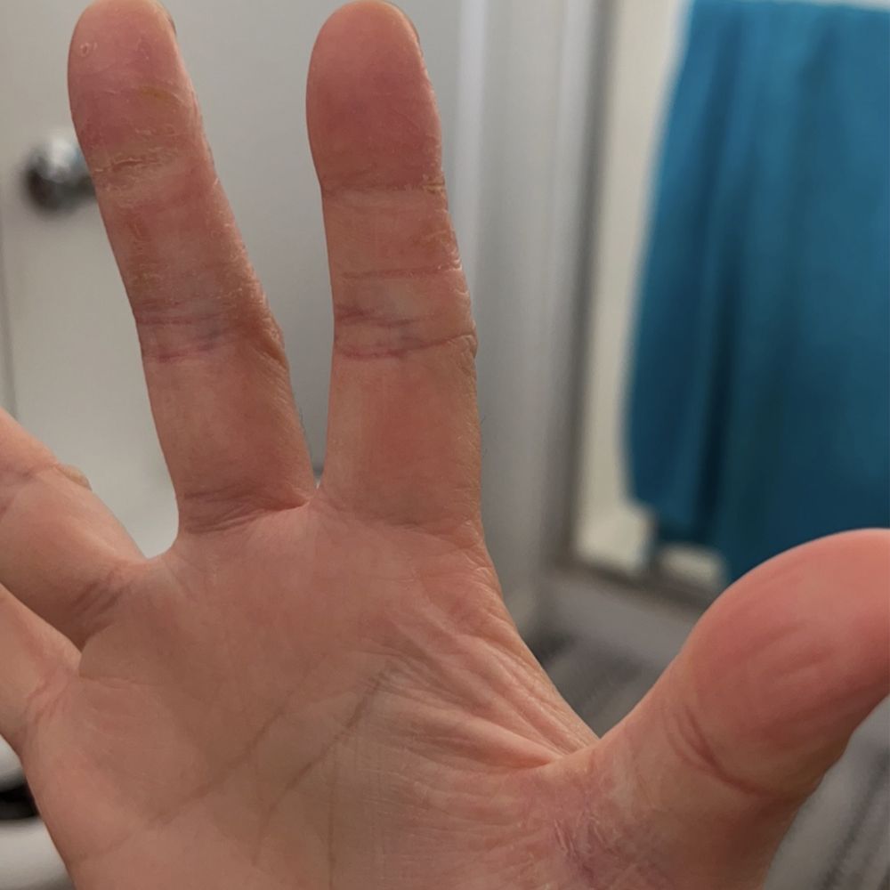 Chosen Acupuncture - After pic: Look at that!!! No more itchy water blisters and painful cracks. - Acupuncture Near Me - Rosemead, California Chosen Acupuncture - After pic: Look at that!!! No more itchy water blisters and painful cracks. - Acupuncture Near Me - Rosemead, California
