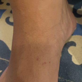 La Terraza - bed bug bites - Hotels Near Me - San Juan, Puerto Rico La Terraza - bed bug bites - Hotels Near Me - San Juan, Puerto Rico