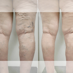 Vena Vein Clinic - Sherman oaks - Varicose veins before and after pictures of VeNA vascular lab & vein clinic patient.