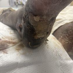 Aurora Manor Special Care Centre - My husbands foot