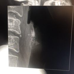 Collin Chiropractic - Thyroid issue