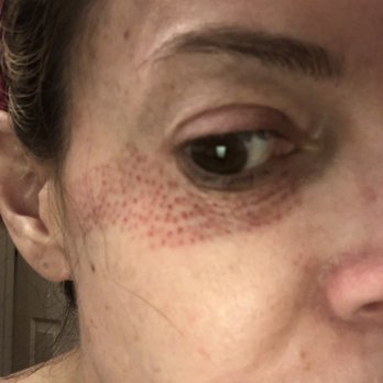 Stellar Skin & Laser - 2 weeks out - Skin Care Near Me - Tempe, Arizona Stellar Skin & Laser - 2 weeks out - Skin Care Near Me - Tempe, Arizona