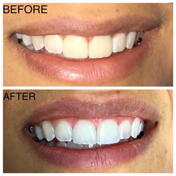 Tehrani Smiles - 2 Upper Porcelain Veneers to improve Color. LOOK how natural the results are ! - Cosmetic Dentists Near Me - Mammoth Lakes, California Tehrani Smiles - 2 Upper Porcelain Veneers to improve Color. LOOK how natural the results are ! - Cosmetic Dentists Near Me - Mammoth Lakes, California