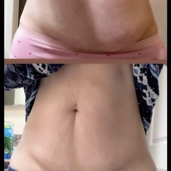 Her Majesty Body Sculpting By Ty - This beauty was treated with Ultrasonic Cavitation and Skin Tightening. Her results were amazing!! - Body Contouring Near Me Her Majesty Body Sculpting By Ty - This beauty was treated with Ultrasonic Cavitation and Skin Tightening. Her results were amazing!! - Body Contouring Near Me
