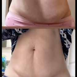 Her Majesty Body Sculpting By Ty - This beauty was treated with Ultrasonic Cavitation and Skin Tightening. Her results were amazing!!