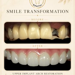 San Antonio Dentist - Crownridge Dental - Christian Pham, DMD - Before and after Upper implant arch transformation to regain the confidence they wanted!
